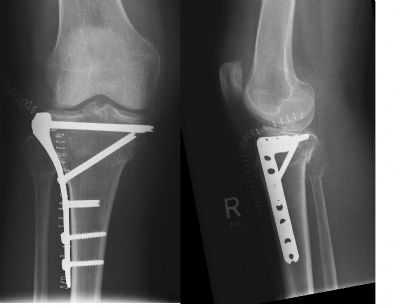 Synthes Locking Tibial Plate (Implant 22)